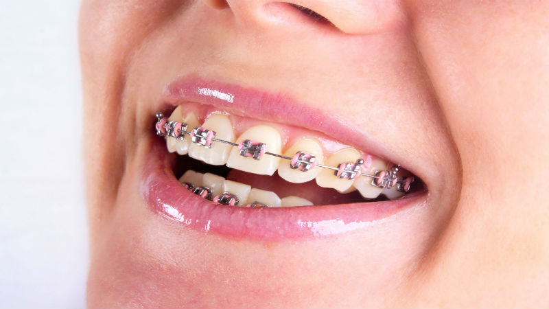 Braces and Orthodontic Specialists in Queens NY Helps You Smile Your Best