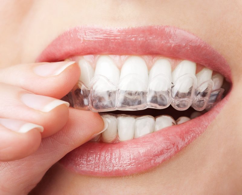 Beautifying Your Smile with a Dental Implant in Nassau County, NY