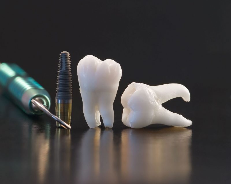 How to Take Proper Care of Dental Implants in Summit, NJ