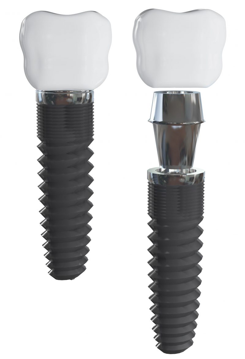 5 Excellent Reasons Why You Should Choose Dental Implants