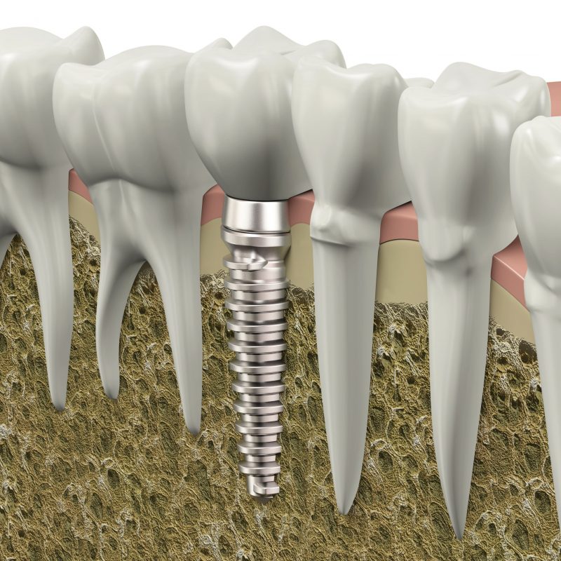 Dental Implants Help Patients Have Beautiful Smiles