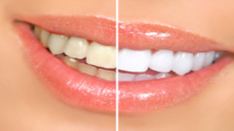 How a Dentist in Spring Can Improve the Appearance of Your Teeth