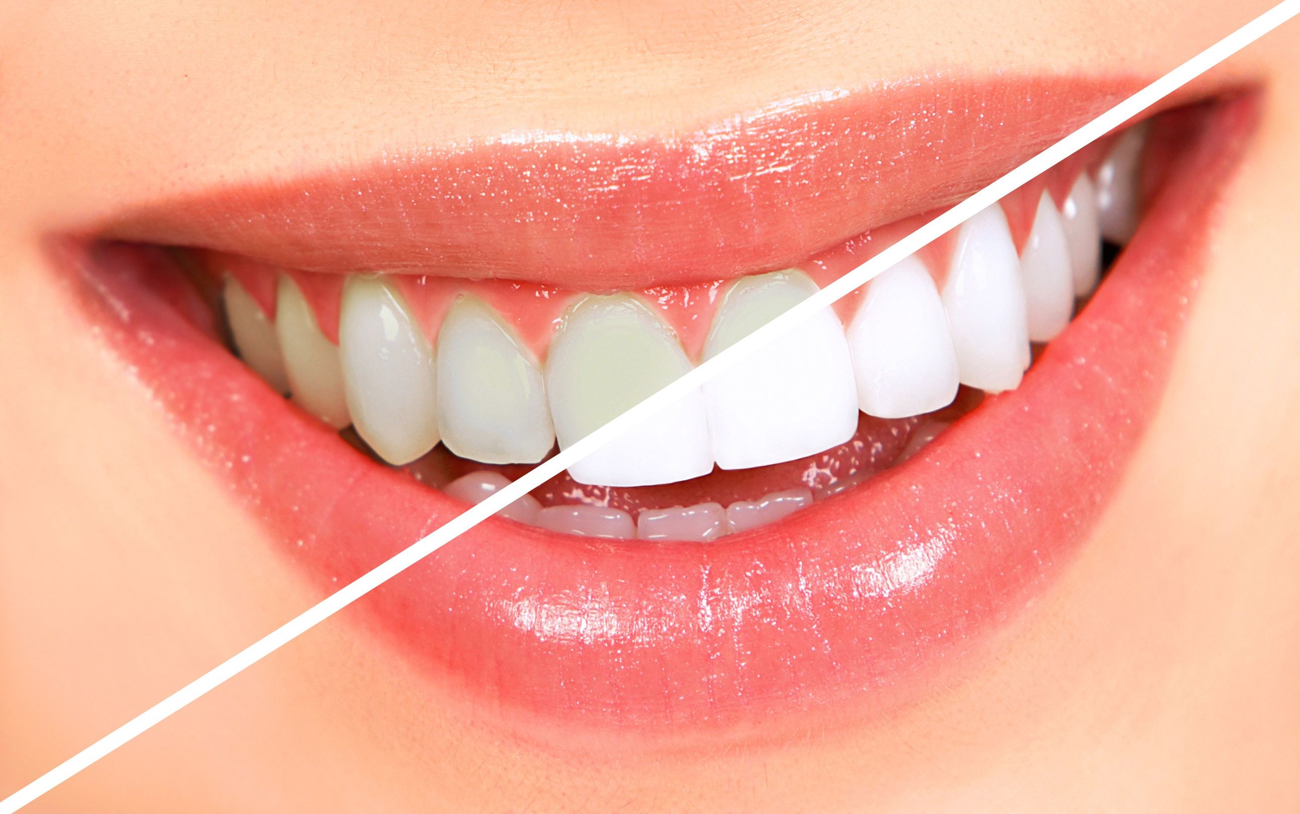 What is Teeth Bonding in Midwest City OK?