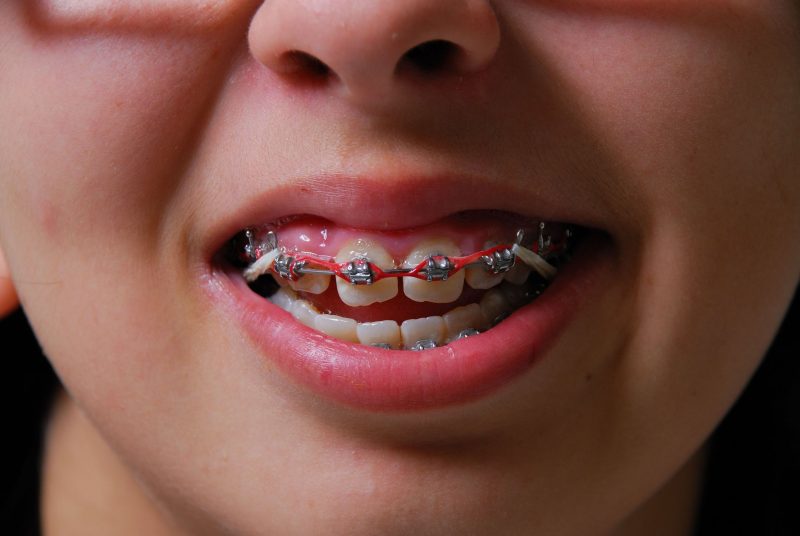 Experience the Benefits of Metal Braces in Long Beach, CA